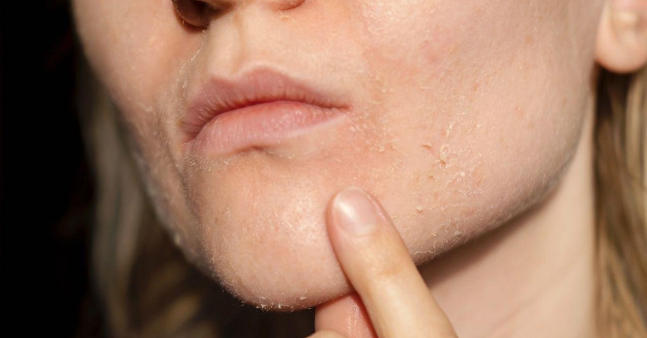 Close-up of a person's chin and lips with dry, flaky skin