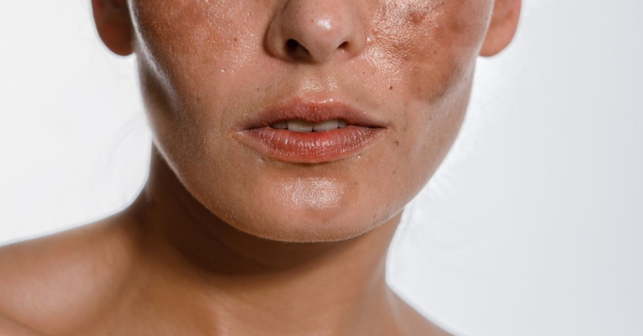 Close-up of a woman's face showing melasma and hyperpigmentation on her cheeks