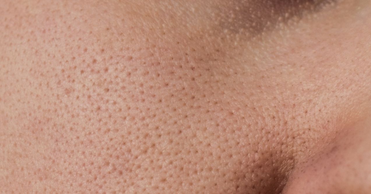 Close-up image of skin with visible clogged pores