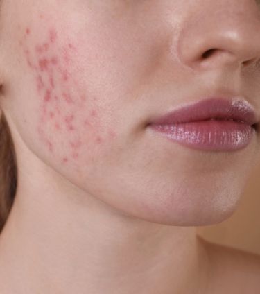 Close-up of a woman's cheek showing red retinol purge marks and irritation