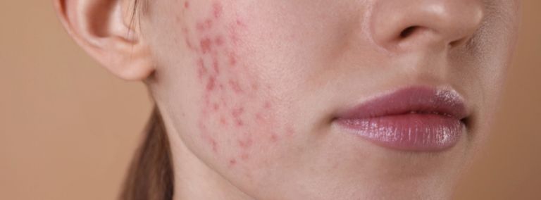 Close-up of a woman's cheek showing red retinol purge marks and irritation