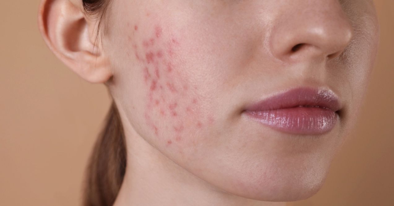 Close-up of a woman's cheek showing red retinol purge marks and irritation