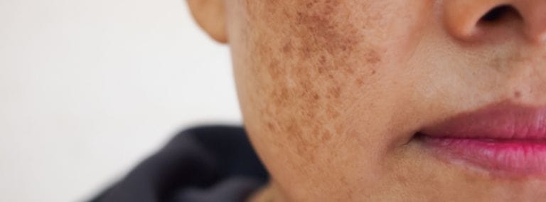 Close-up of a woman's face with hyperpigmentation on the cheek