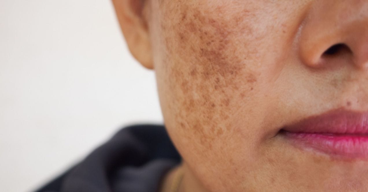 Close-up of a woman's face with hyperpigmentation on the cheek