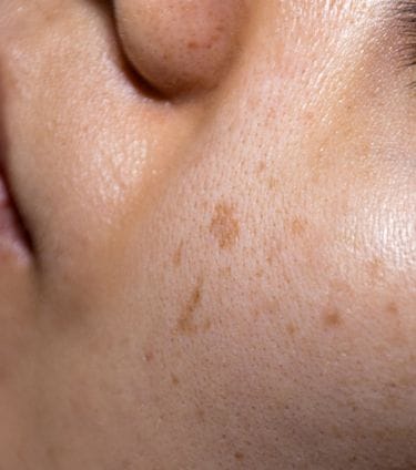 Person's face showing uneven skin tone and dark spots