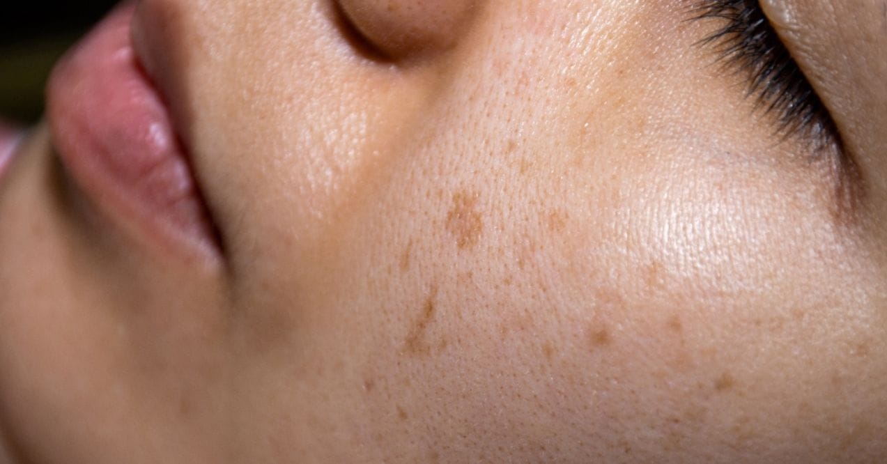 Person's face showing uneven skin tone and dark spots