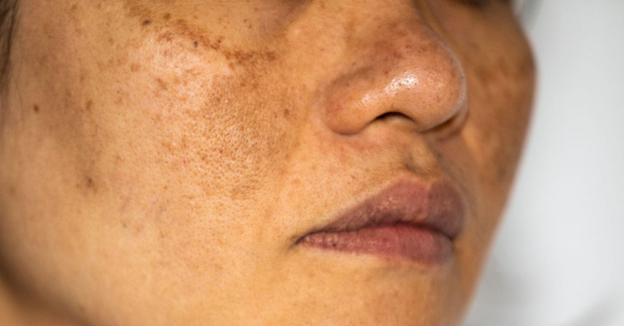 Close-up of a woman's face showing hyperpigmentation on the skin