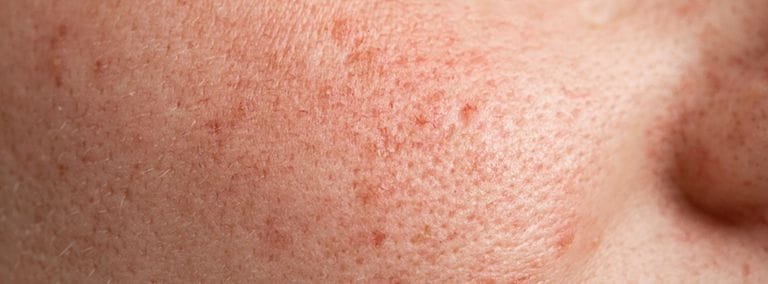 Close-up of blotchy skin with redness and uneven texture