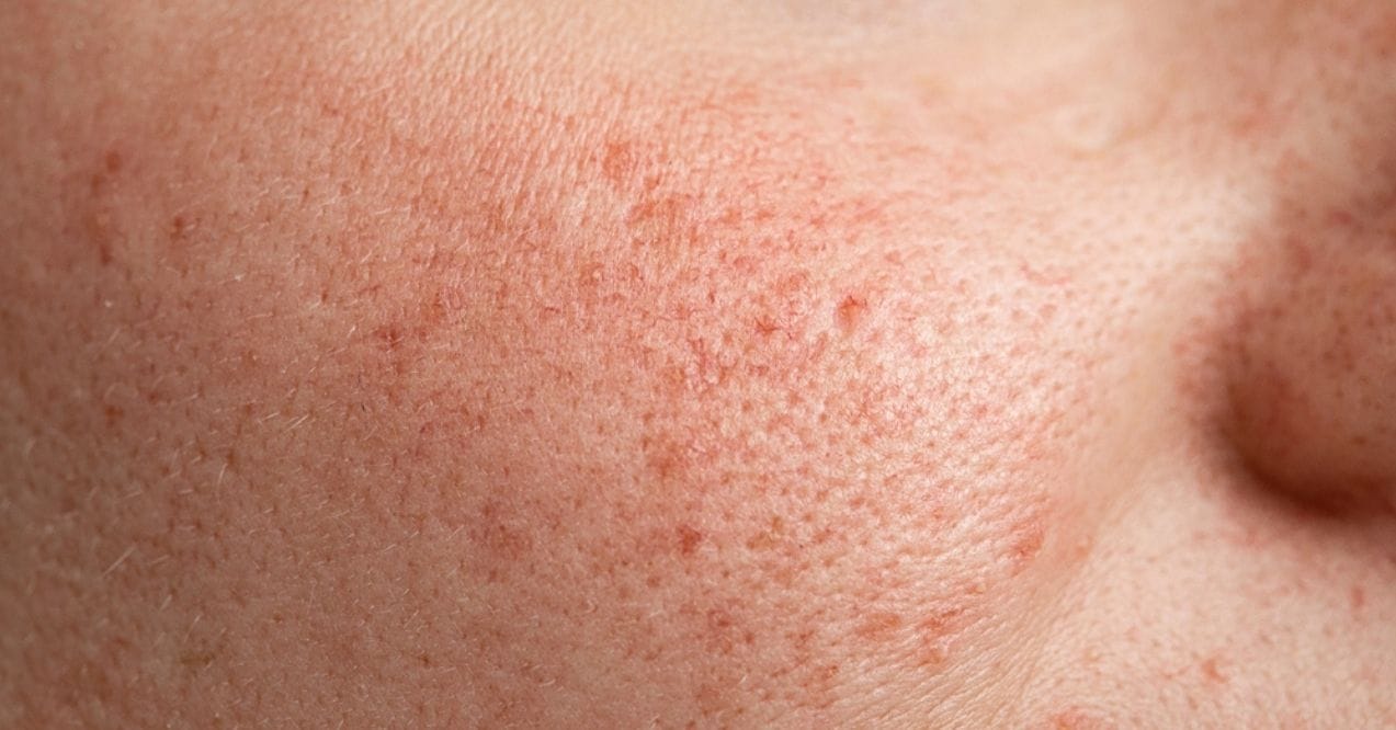 Close-up of blotchy skin with redness and uneven texture