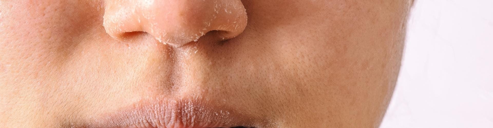 Close-up of dry, flaky skin around the nose and lips