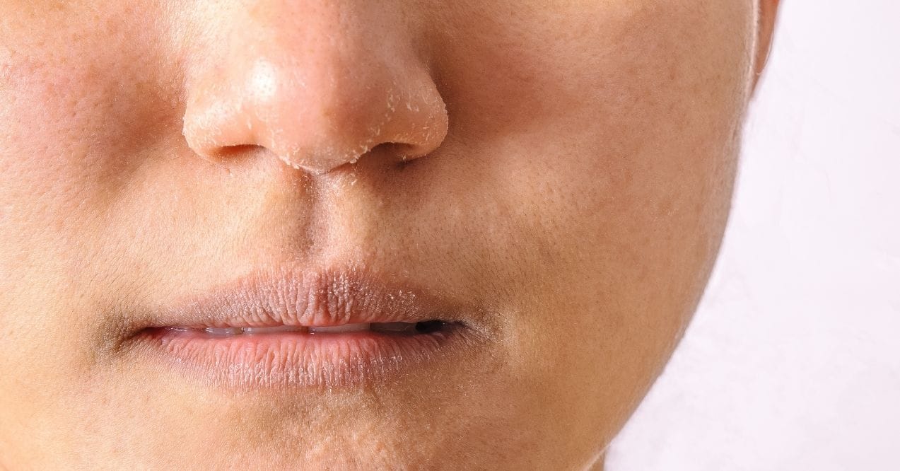 Close-up of dry, flaky skin around the nose and lips