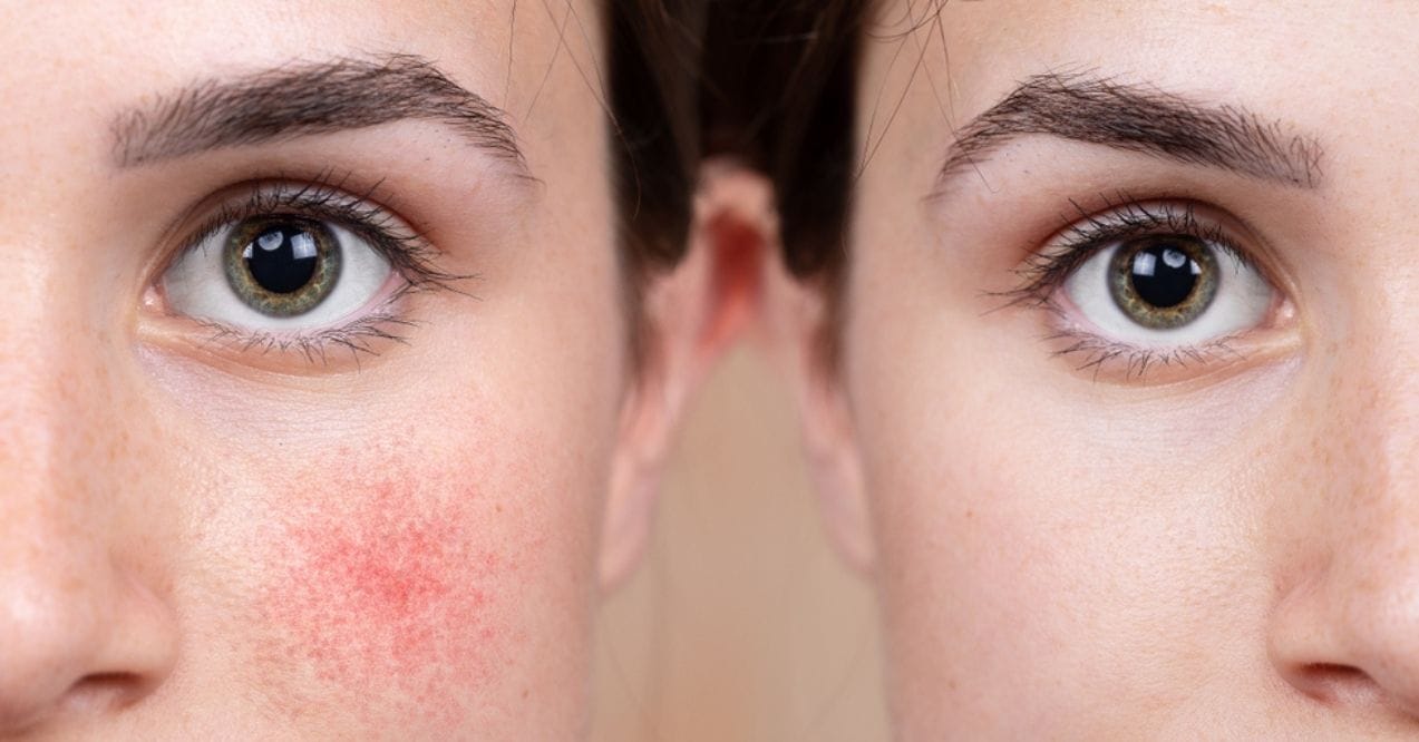 Side-by-side comparison of a woman's face before and after reducing redness on her cheek