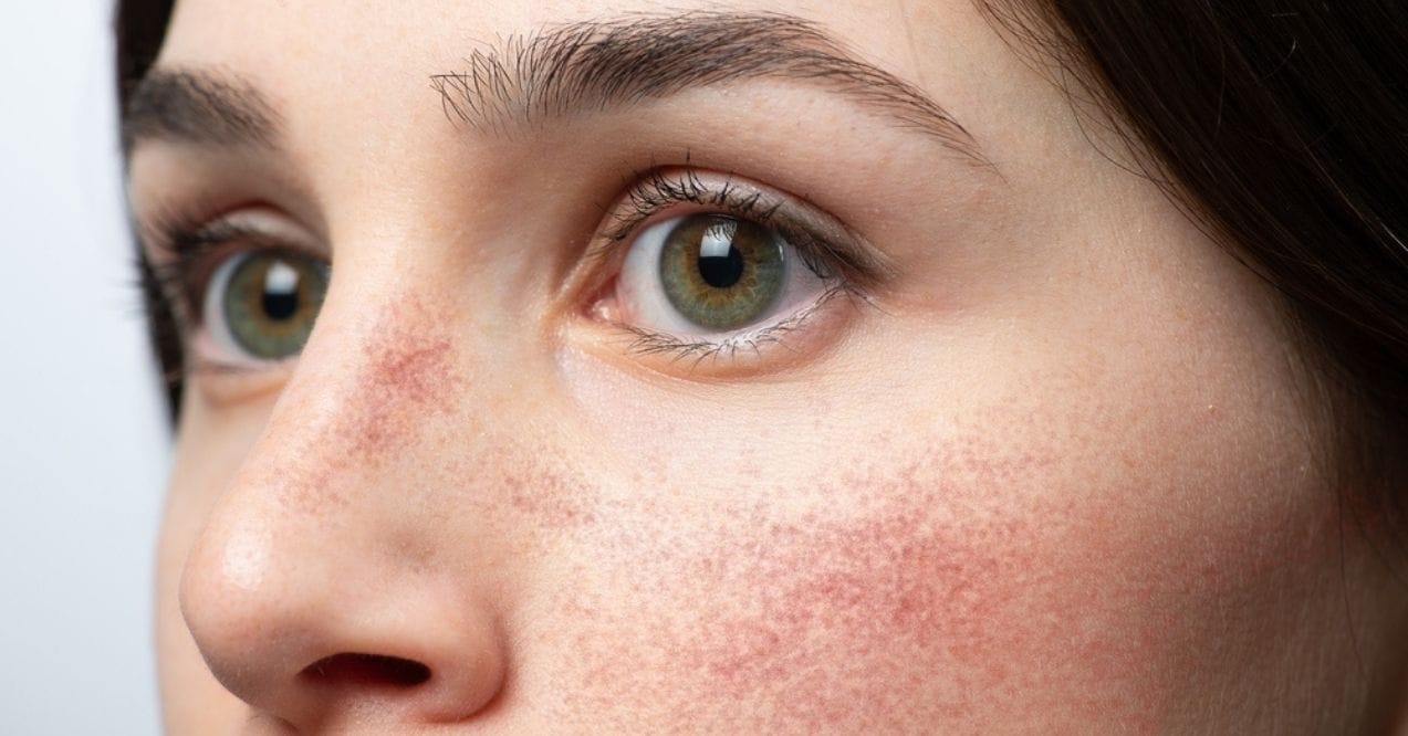 Close-up of a woman's face with redness on her cheeks and nose