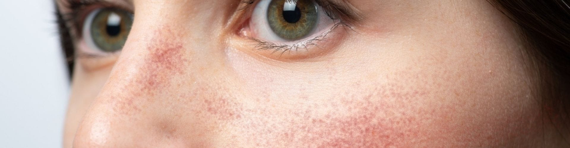 Close-up of a woman's face with redness on her cheeks and nose