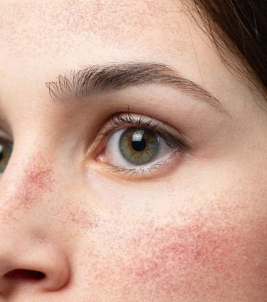 Close-up of a woman's face with redness on her cheeks and nose