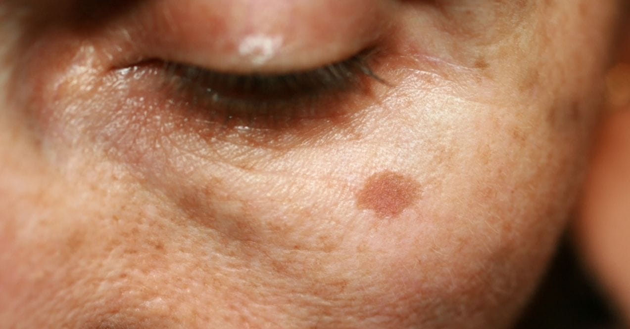 Close-up of an age spot on a person's cheek