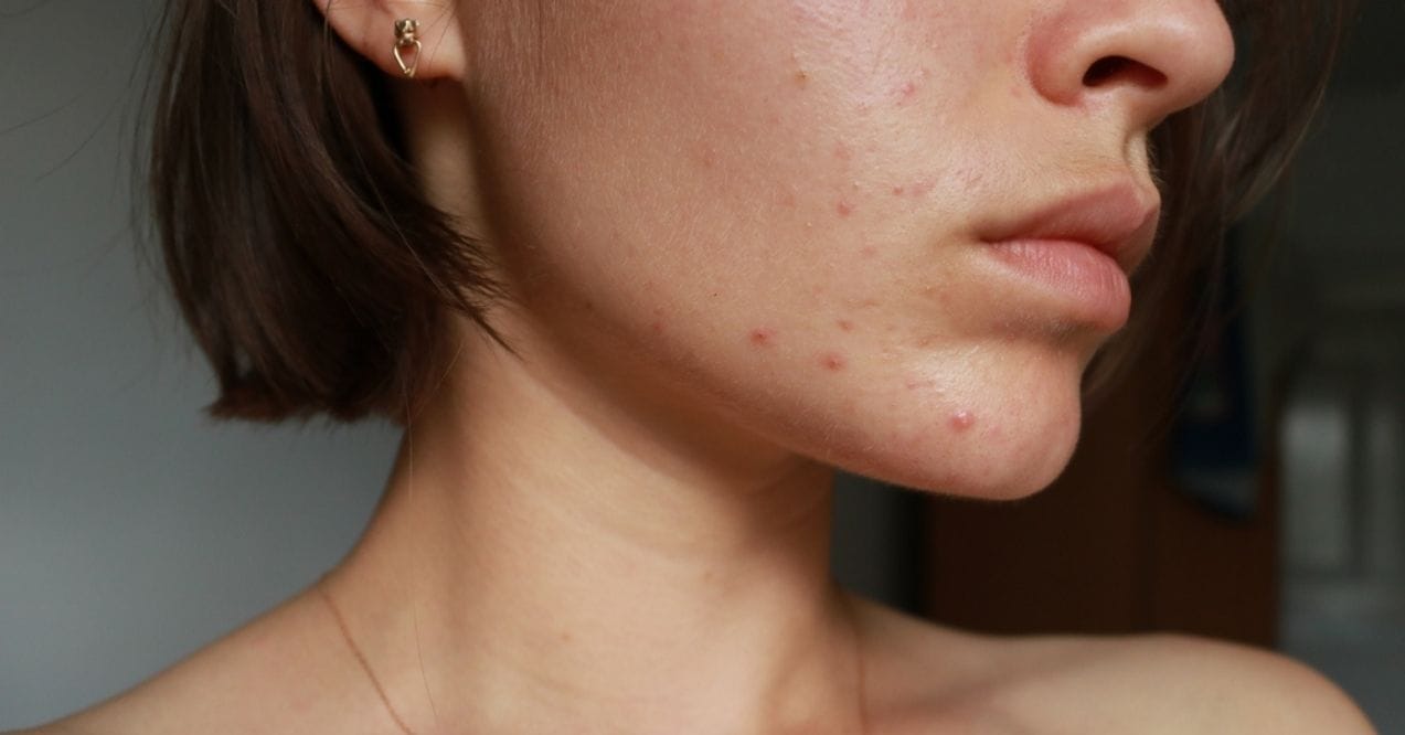 Close-up of a woman's face with acne on her cheek and jawline