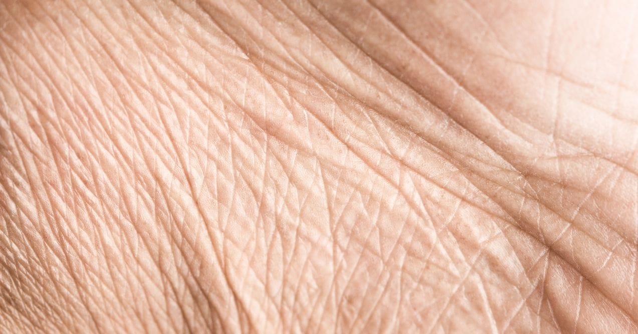 Detailed view of crepey skin texture.