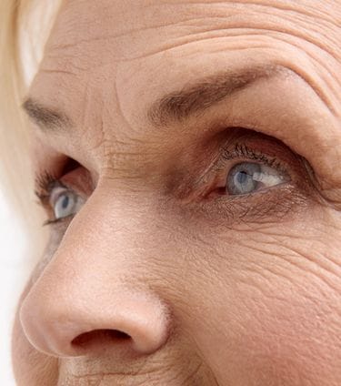 Close-up of crepey skin under eyes
