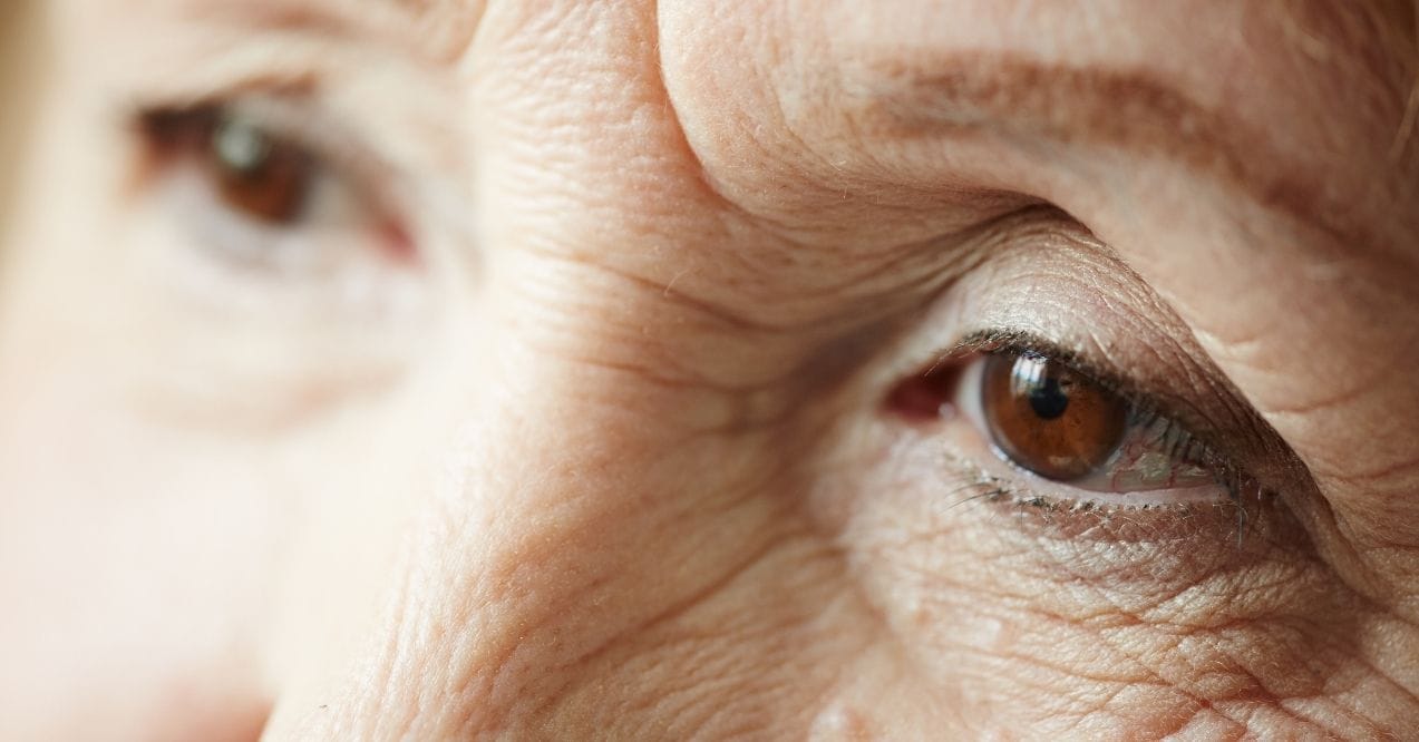 Close-up of crepey skin around eyes