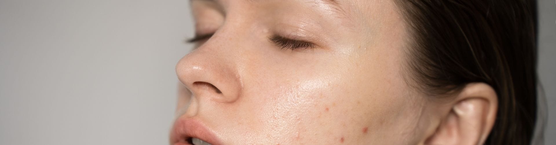 Close-up of a young woman with oily skin and visible acne on her cheek