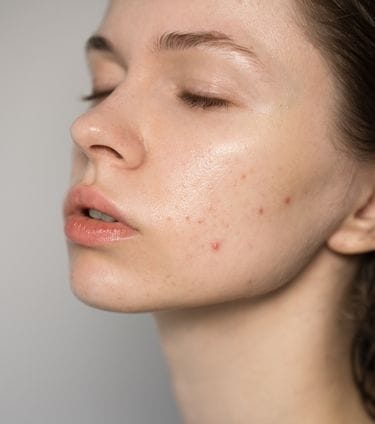 Close-up of a young woman with oily skin and visible acne on her cheek