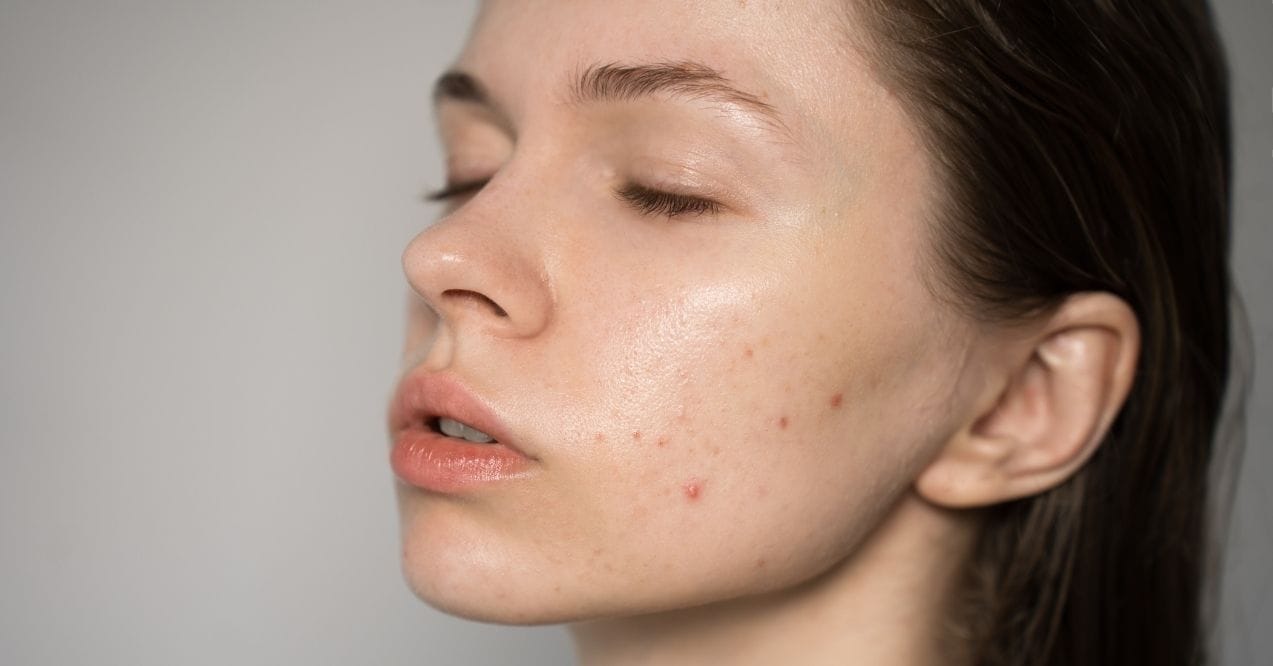 Close-up of a young woman with oily skin and visible acne on her cheek