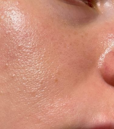 Close-up of a person's cheek with visible pores and oily skin texture